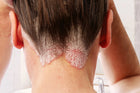 Psoriasis-prone skin
