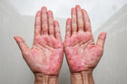 Contact dermatitis