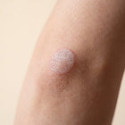 Eczema-prone skin